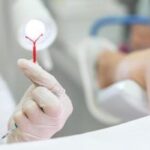 Mutirão de DIU amplia acesso ao planejamento reprodutivo em Goiás