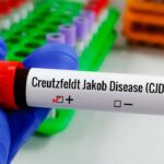 Entenda Doença de Creutzfeldt-Jakob e busca por tratamento