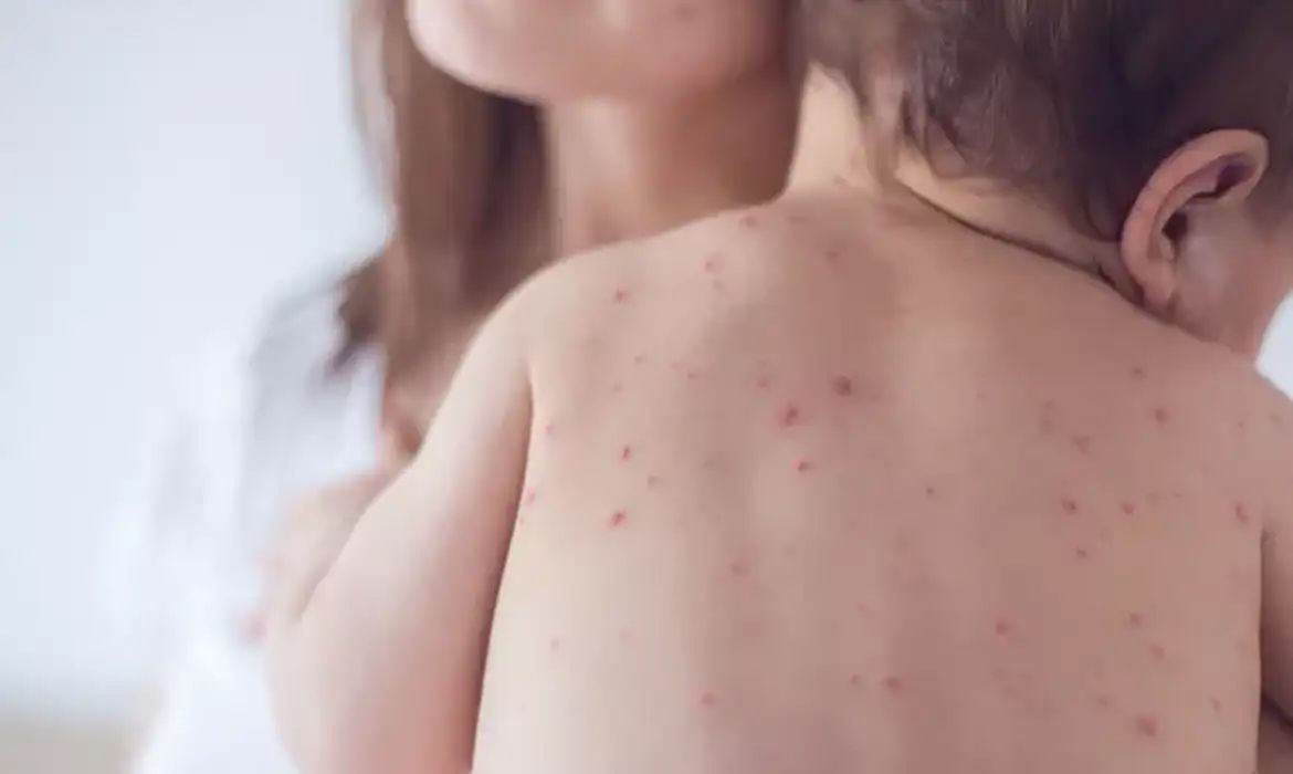 Estado de São Paulo reforça necessidade de vacinação contra o sarampo