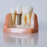 Nova técnica acelera testes de materiais e apoia o desenvolvimento de implantes dentários