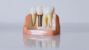 Nova técnica acelera testes de materiais e apoia o desenvolvimento de implantes dentários