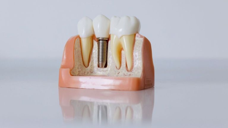 Nova técnica acelera testes de materiais e apoia o desenvolvimento de implantes dentários